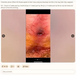 Multiple_fistulas4.jpg