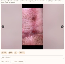 Multiple_fistulas5.jpg