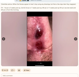 Multiple_fistulas6.jpg