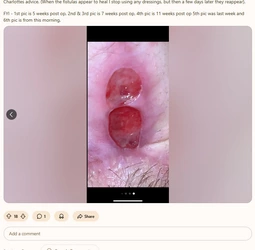 Multiple_fistulas7.jpg