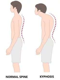 Kyphosis-scaled.jpg