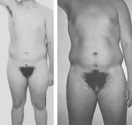 Grade_3_partial_androgen_insensitivity_syndrome.jpg