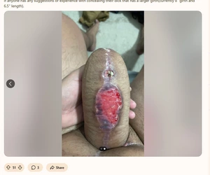 Keloid_phallo2.jpg