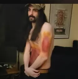 tottally real bruises.PNG