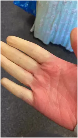 Raynauds-hand.png