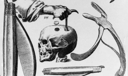 hole-in-head-lede-700x420.jpg