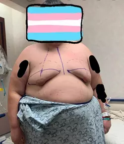 two-days-post-op-v0-1bqakywd2g5e1.webp