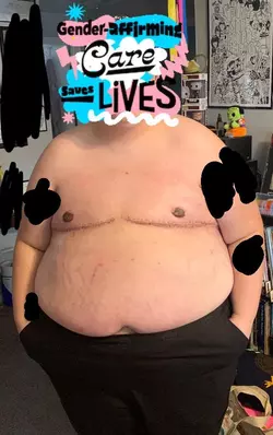 3-weeks-post-op-v0-l5k95fxpk99e1.webp