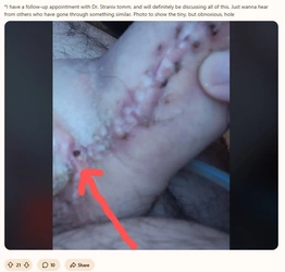 Phallo_fistula2.jpg