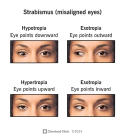 strabismus-eye-misalignment.jpg