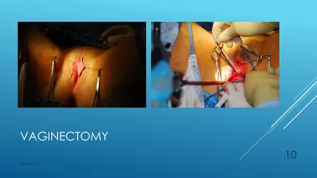 Santucci-Complications_of_Phalloplasty_Fried_Symposium_2019_010.jpg