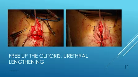 Santucci-Complications_of_Phalloplasty_Fried_Symposium_2019_011.jpg