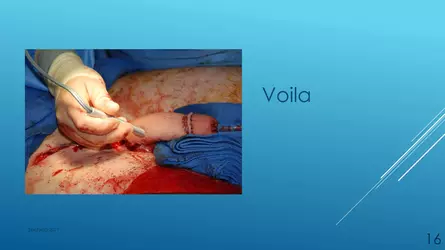 Santucci-Complications_of_Phalloplasty_Fried_Symposium_2019_016.jpg