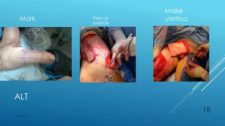 Santucci-Complications_of_Phalloplasty_Fried_Symposium_2019_018.jpg