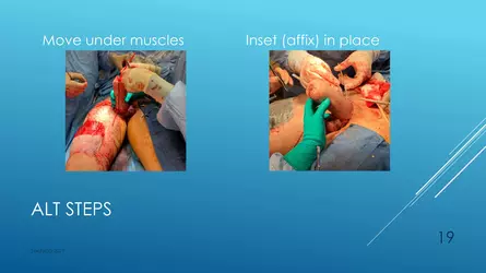 Santucci-Complications_of_Phalloplasty_Fried_Symposium_2019_019.jpg