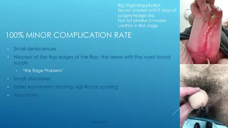 Santucci-Complications_of_Phalloplasty_Fried_Symposium_2019_025.jpg