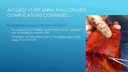 Santucci-Complications_of_Phalloplasty_Fried_Symposium_2019_028.jpg
