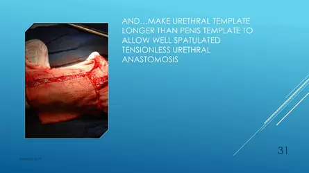 Santucci-Complications_of_Phalloplasty_Fried_Symposium_2019_031.jpg