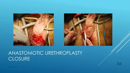 Santucci-Complications_of_Phalloplasty_Fried_Symposium_2019_036.jpg