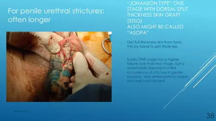 Santucci-Complications_of_Phalloplasty_Fried_Symposium_2019_038.jpg