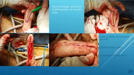 Santucci-Complications_of_Phalloplasty_Fried_Symposium_2019_039.jpg