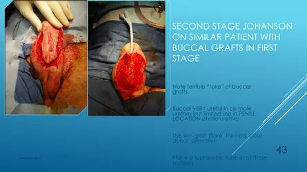 Santucci-Complications_of_Phalloplasty_Fried_Symposium_2019_043.jpg