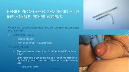 Santucci-Complications_of_Phalloplasty_Fried_Symposium_2019_045.jpg