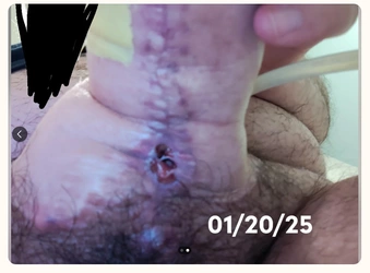 Fistula_woes2.jpg