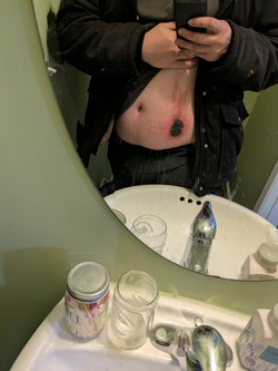nitrogen burn.jpg nitrogen burn.jpg