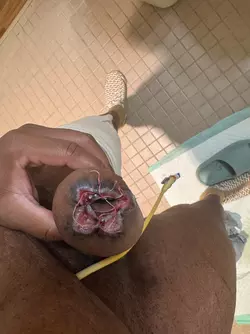 open-wound-on-tip-of-phallus-update-v0-nfqduwffi9he1.webp