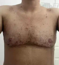 holes-in-scar-is-it-bad-v0-z55c7va2vxge1.webp