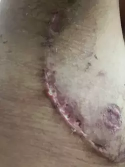 holes-in-scar-is-it-bad-v0-e64kuua2vxge1.webp
