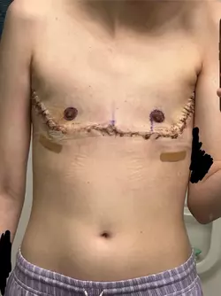 2-weeks-post-op-weird-incision-shape-v0-3pdmkaxf2rge1.webp
