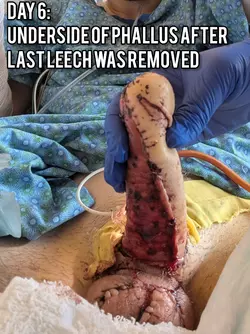 phalloplasty-with-dr-gallegos-v0-qh6jfhm8dehe1.webp