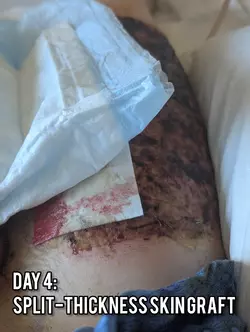 phalloplasty-with-dr-gallegos-v0-91xtmfj7dehe1.webp