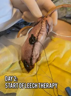 phalloplasty-with-dr-gallegos-v0-1ksqpmj6dehe1.webp