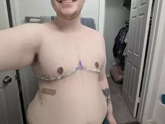 8-days-post-op-di-with-dr-kassis-at-vanderbilt-v0-eh24fuiuwrhe1.webp