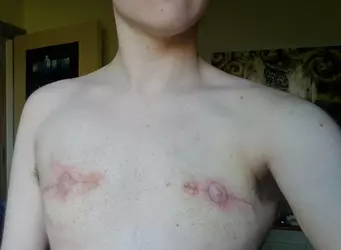 2-months-post-op-fishmouth-batwing-with-dr-schäfer-gender-v0-qg8kwilhgax81.webp