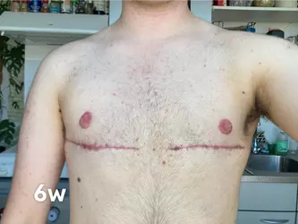 6-weeks-post-op-double-incision-with-dr-schäfer-at-gender-v0-fpnt23cj9dzc1.webp