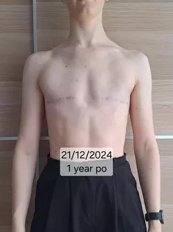 1-year-post-op-today-bonus-at-the-end-v0-qbqzl939g98e1.webp