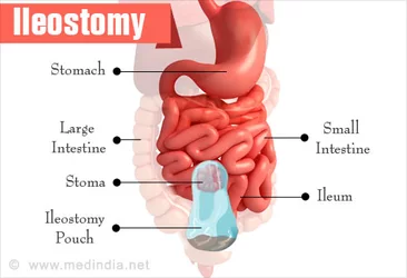 diet-for-ileostomy[1].jpg