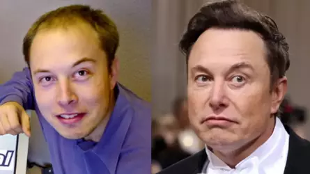 Before-and-After-Hair-Transplant-_-Elon-Musk-1.webp