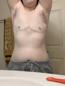 5-mo-post-op-v0-3s6zw3ysguje1.webp