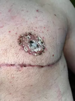 nipple-scabbing-help-v0-7z1sg06g7yke1.webp