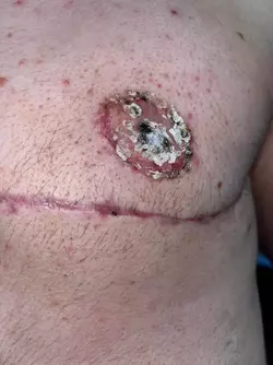 nipple-scabbing-help-v0-fikr126g7yke1.webp