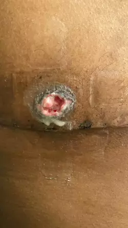 nipple-graft-failed-v0-0f8rygfjmkle1.webp