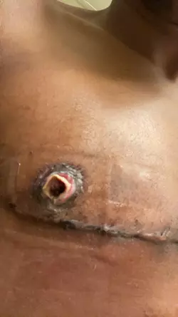 nipple-graft-failed-v0-7i2yohfjmkle1.webp