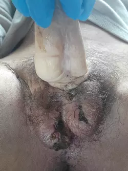 one-month-post-op-stage-two-dr-shane-morrison-v0-kxgkw30cgrzd1.webp