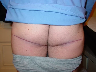 buttock-scaring.jpg buttock-scaring.jpg