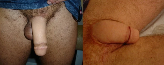 radial-artery-phalloplasty.jpg radial-artery-phalloplasty.jpg